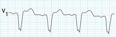 ECG left bundle branch block (LBBB), broad QRS complex