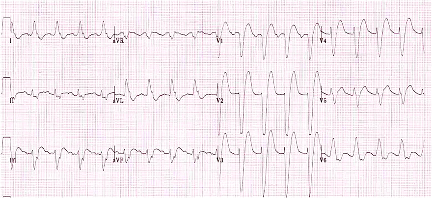 Left Bundle Branch Block - ECG book