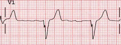 ECG (V1) LBBB, QRS M-shaped QRS morphology