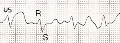 ECG (V5) LBBB RS complex morphology