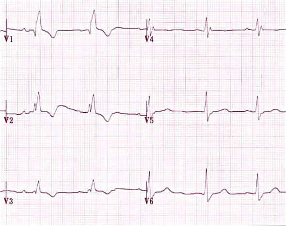 Right Bundle Branch Block - ECG book