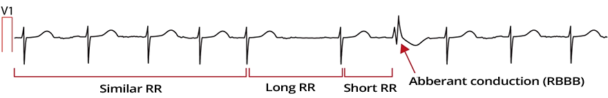 Right Bundle Branch Block - ECG book