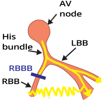 Heart conduction system, Right Bundle Branch Block (RBBB)