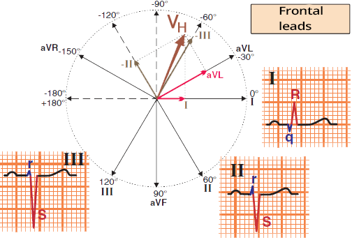 Left Anterior Fascicular Block - ECG book