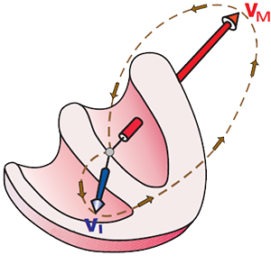 electrical vector deviation, and left anterior hemiblock