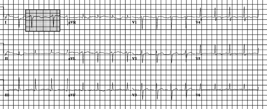 ECG left posterior Fascicular Block, right axis deviation, narrow QRS, prolonged R wave peak aVF