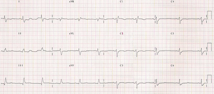 ECG bifascicular block (LPFB + RBBB)