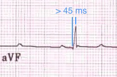 ECG Left Posterior Fascicular Block (LPFB), Prolonged R wave peak time in aVF 45ms, negative QRS I lead, positive QRS III lead