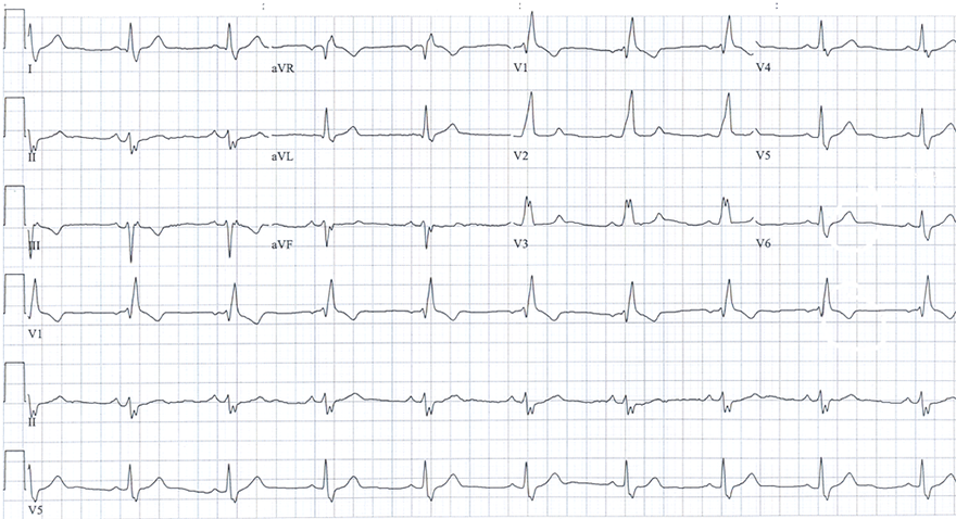 ECG bifascicular block (RBBB + LAFB)