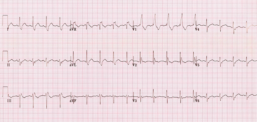 ECG bifascicular block (RBBB + LAFB)