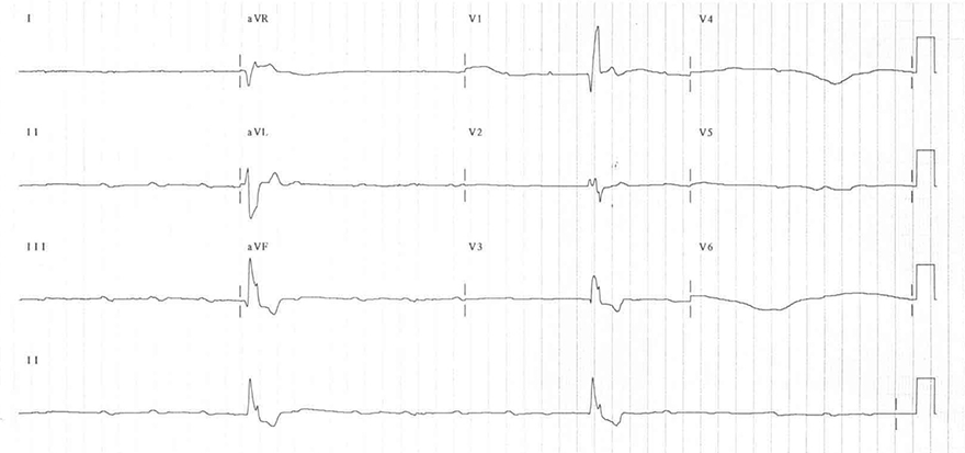 ECG idio-ventricular rhythm, and 3rd degree av complete block, av dissociation, broad qrs