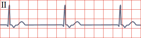 ECG junctional rhythm, narrow QRS complexes