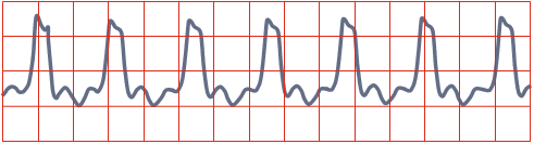 ECG ventricular escape rhythm