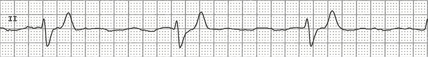 ECG ventricular rhythm, broad qrs complexes