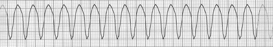 ECG ventricular tachycardia, 160bpm, broad QRS complexes