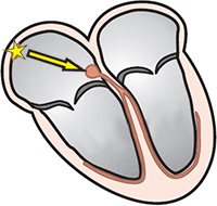 sinus rhythm