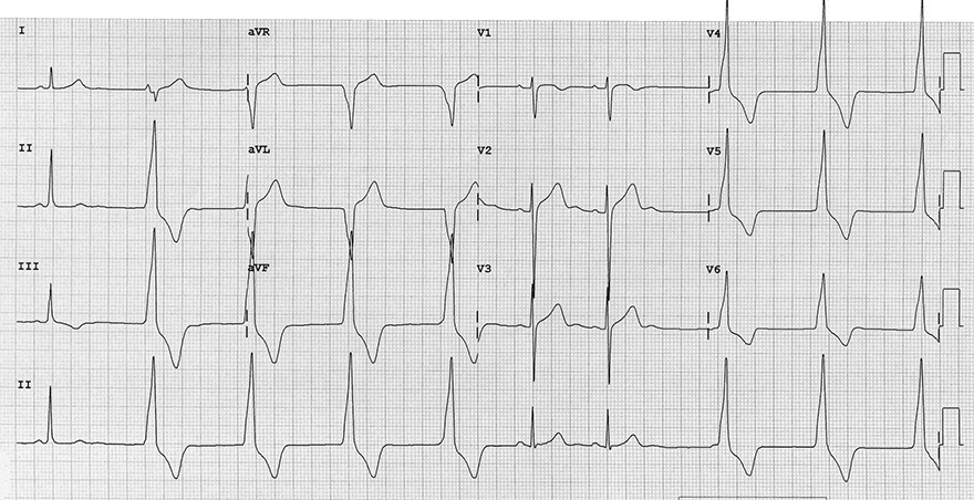 ECG accelerated idio-ventricular rhythm, 60 bpm, fusion beats, capture beats