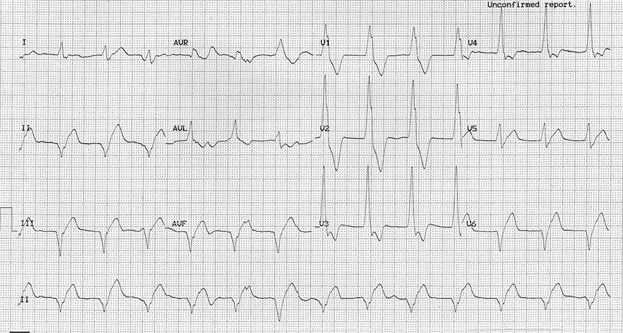 ECG accelerated ectopic junctional rhythm, 75 bpm, fusion beat, capture beat