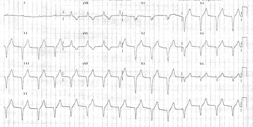 ECG accelerated ventricular rhythm