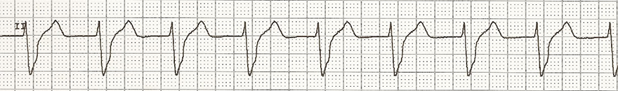 ECG accelerated ventricular rhythm, broad qrs complexes, 80 bpm