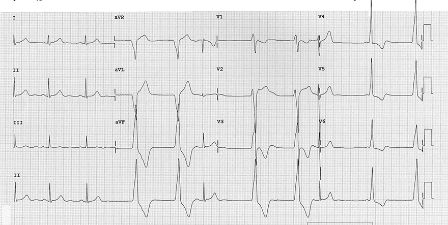 ECG sinus rhythm, and accelerated idio-ventricular rhythm, capture beat