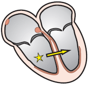 ectopic ventricular focus LBBB pattern