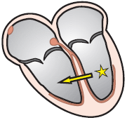 ventricular ectopic focus, RBBB pattern