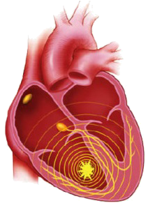 accelerated idioventricular escape rhythm