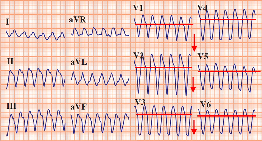 ECG ventricular tachycardia negative concordance