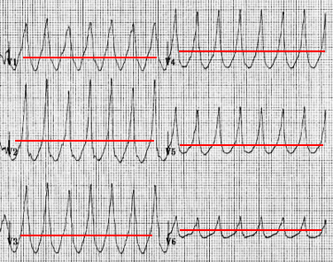 ECG ventricular tachycardia positive concordance