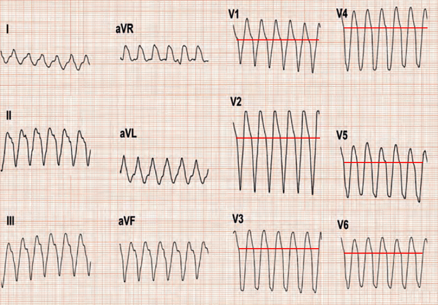 ECG ventricular tachycardia, negative concordance