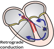 Ventricular tachycardia, retrograde ventriculoatrial (VA) conduction