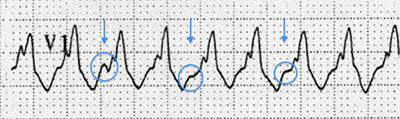 ECG AV dissociation, monomorphic ventricular tachycardia