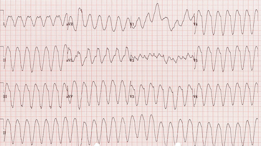 ECG sustained monomorphic ventricular tachycardia (VT)