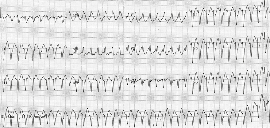 ECG monomorphic ventricular tachycardia, av dissociation