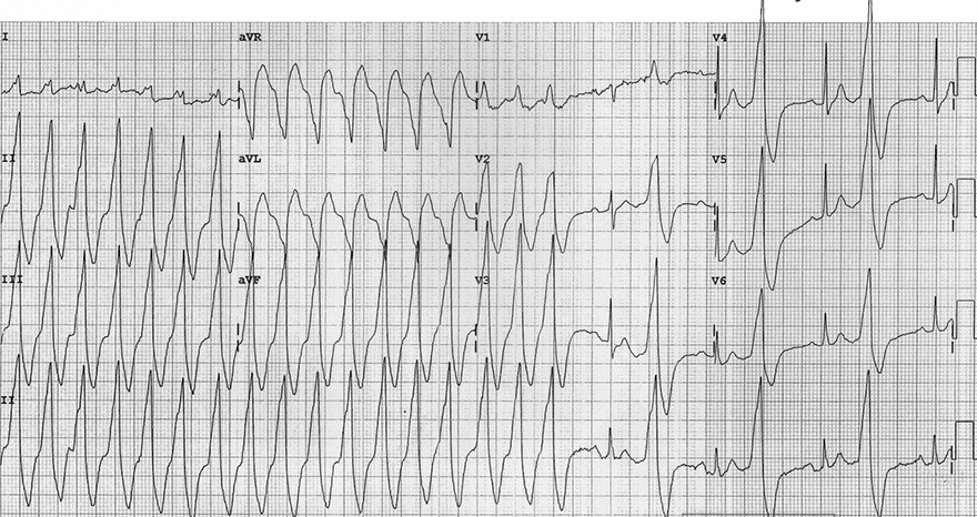 ECG monomorphic VT, ventricular bigeminy, brugada, sign