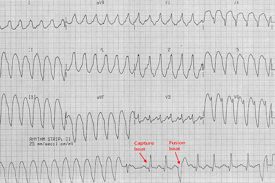 ECG monomorphic ventricular tachycardia, fusion beat, positive concordance, brugada sign, RS interval, r wave peak time lead II