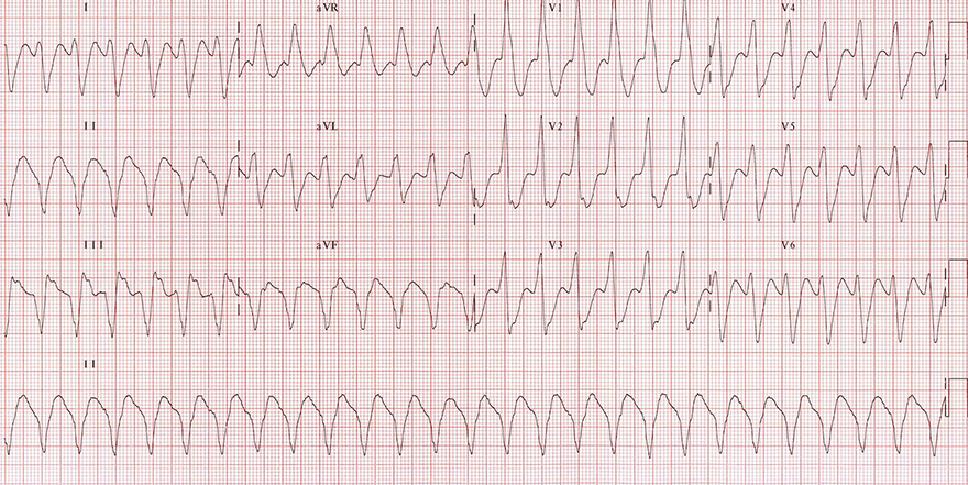 ECG monomorphic ventricular tachycardia, extreme right axis, brugada sign, josephson sign, R Wave Peak Time