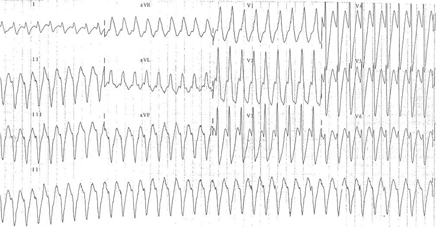 ECG monomorphic wide complex tachycardia, 