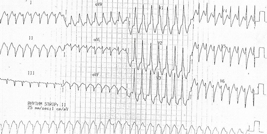 ECG monomorphic ventricular tachycardia, 180bpm, left rabbit ear sign