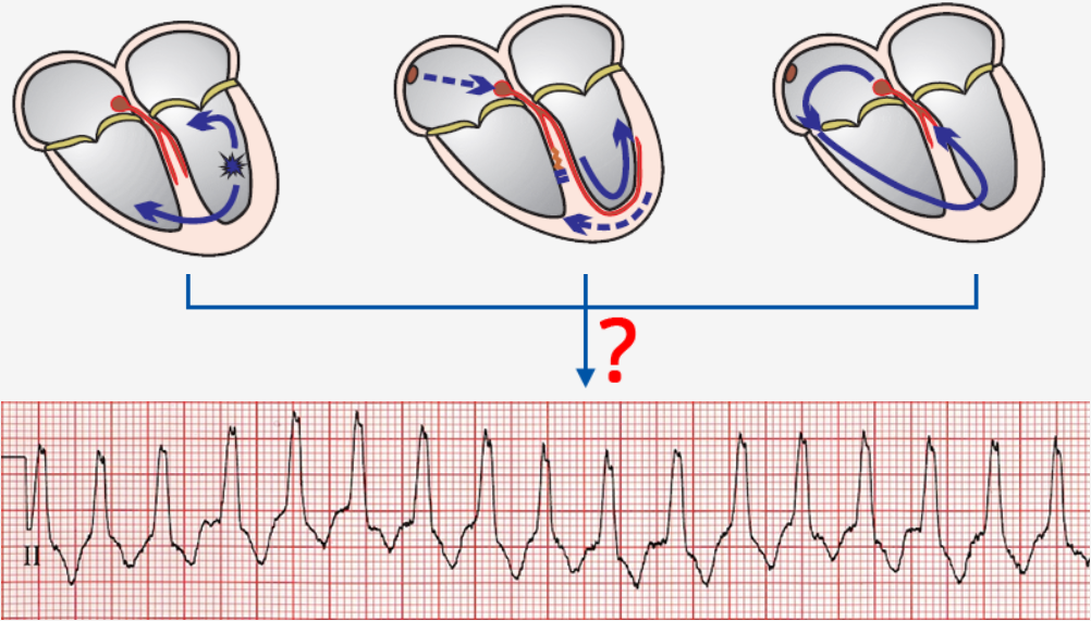 Difference between SVT and VT on ECG