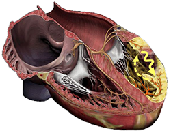 Monomorphic ventricular tachycardia, myocardial scarring, reentry mechanism