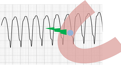 ECG monomorphic ventricular tachycardia (VT), single exit site, single ventricular focus