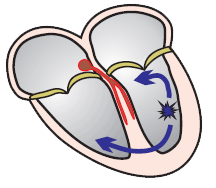 Wide complex tachycardia, monomorphic ventricular tachycardia