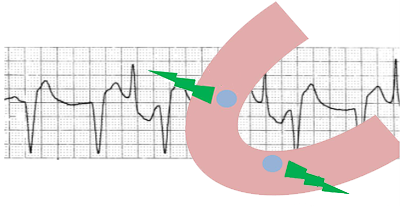 ECG polymorphic ventricular tachycardia bifocal, Bidirectional ventricular tachycardia