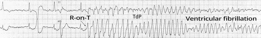 ECG Long QT interval, Phenomenon R on T, Torsades de Pointes (twisting morphology), Ventricular fibrillation