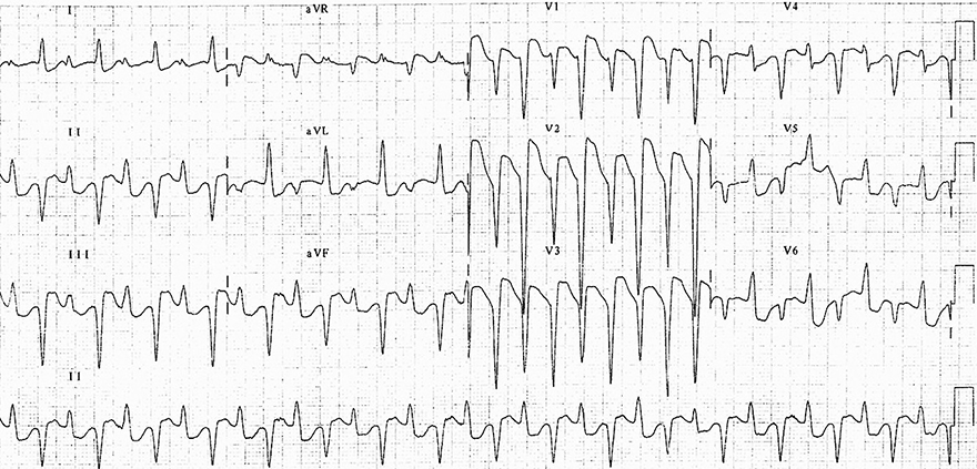 ECG Bidirectional Ventricular Tachycardia, axis shifts 180 degrees, severe digoxin toxicity