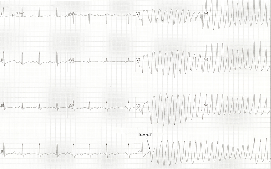 ECG polymorphic VT, Torsades de Pointes, Phenomenon R on T, Prolonged QT