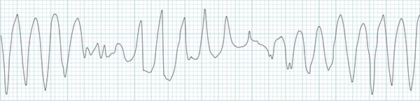 ECG polymorphic ventricular tachycardia