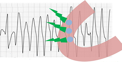 ECG polymorphic ventricular tachycardia, multiple focus, multiple exit sites